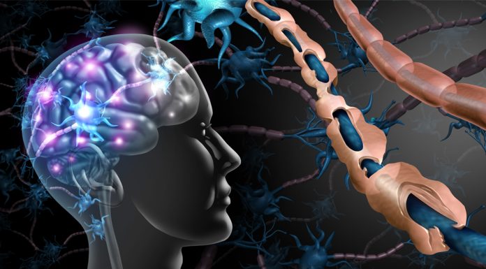 Scleroza multipla: simptome, cauze si tratamente