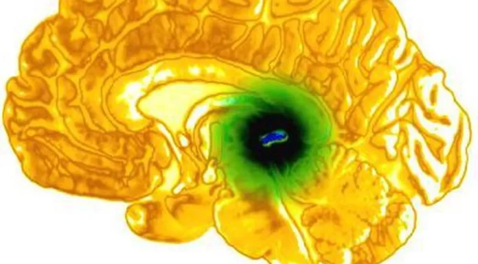 Ce este chistul din glanda pineala?: Cauze, simptome, diagnostic