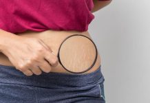 Ulei de cocos pentru vergeturi – Beneficii si utilizari