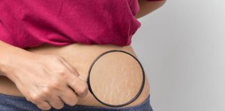 Ulei de cocos pentru vergeturi – Beneficii si utilizari