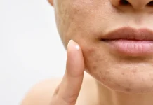 10 remedii naturale pentru a face cicatricile de acnee sa dispara