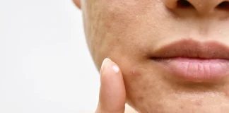 10 remedii naturale pentru a face cicatricile de acnee sa dispara