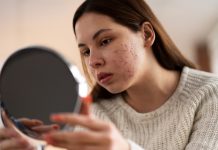 Stiti ca exista 4 tipuri de acnee hormonala?