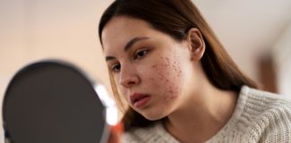 Stiti ca exista 4 tipuri de acnee hormonala?